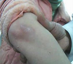 牛皮癣的发病原因有哪些呢