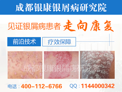 成都银康银屑病医院 成都银康银屑病医院