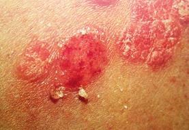 成都银屑病研究院附属医院 秋季如何不让牛皮癣复发