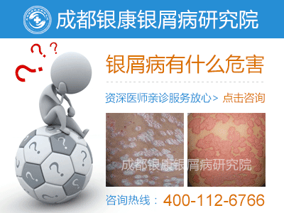 成都治疗银屑病 成都治疗银屑病