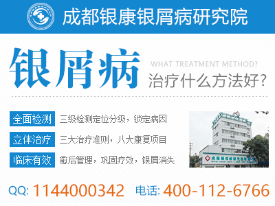 成都治疗牛皮癣医院好不好 成都治疗牛皮癣医院好不好