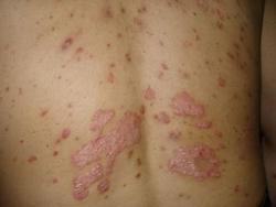 成都银康银屑病研究院附属医院 治疗牛皮癣不能用偏方