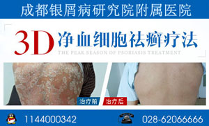 怎么治 首选成都银屑病研究院