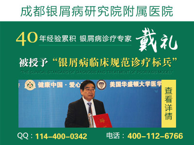 成都牛皮癣哪治疗好