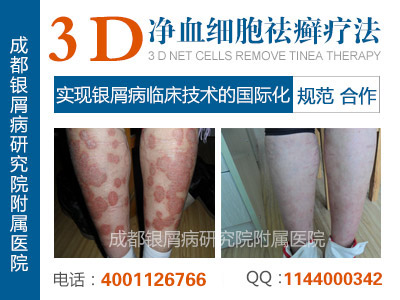 成都银屑病研究院附属医院 成都银屑病研究院附属医院