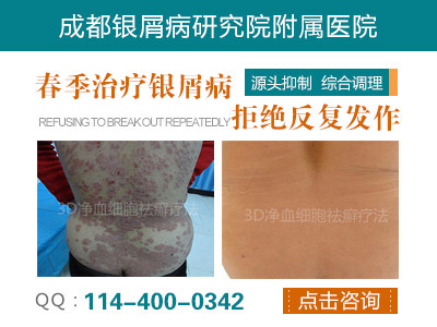 成都银屑病研究院附属医院 成都银屑病研究院附属医院