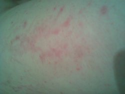 银屑病的早期症状