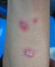 早期牛皮癣的图片