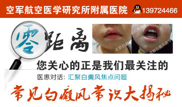 白癜风的治疗是怎么样的呢