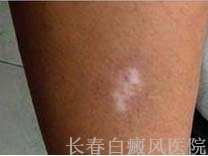 白癜风发病原因有哪些 白癜风发病原因有哪些