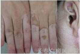 长春哪家看白癜风效果好