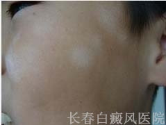 白癜风与虫斑应如何区分