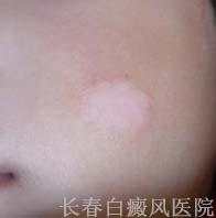 白癜风初期怎么诊断