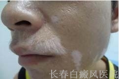 身上的白斑是白癜风吗
