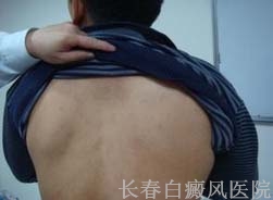 白癜风容易误诊的原因有哪些 白癜风容易误诊的原因有哪些