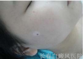 白化病与白癜风怎么区分