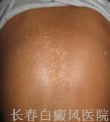 身上出现白癜风怎么诊断