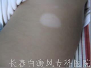白癜风怎么及时诊断