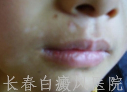 早期白癜风如何识别
