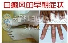 长春白癜风医院哪家好