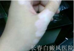 白癜风病情加重有什么表现 白癜风病情加重有什么表现