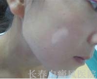 白癜风有哪些分类