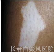 白癜风不同时期有什么症状 白癜风不同时期有什么症状