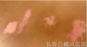 了解白癜风的高发部位 了解白癜风的高发部位