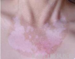 白癜风是由什么引起的 白癜风是由什么引起的