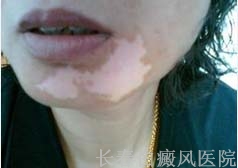 白癜风为什么治不好 白癜风为什么治不好
