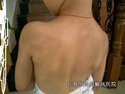 儿童白斑病的四大护理原则 儿童白斑病的四大护理原则