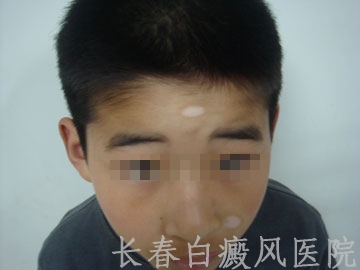 小孩额头有白癜风怎么治