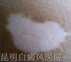 白癜风有什么原因