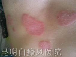 白癜风有什么病因