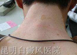 白癜风有哪些原因