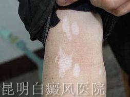 白癜风会不会遗传