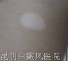 白癜风能治愈吗