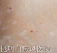 白癜风有哪些偏方