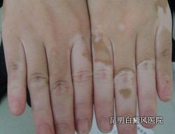 白癜风的诊断依据
