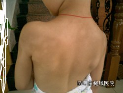 散发型白癜风如何正确诊断