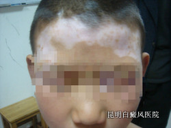 面部白癜风如何诊断
