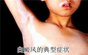 如何正确诊断白癜风 如何正确诊断白癜风