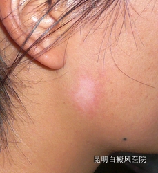 如何自我诊断面部白癜风