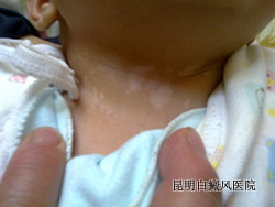 少儿白癜风应如何诊断