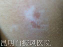白癜风的症状