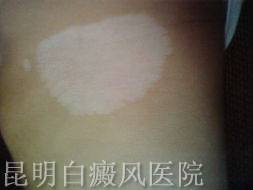 白癜风要如何治疗