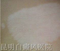 白殿风可以治好吗
