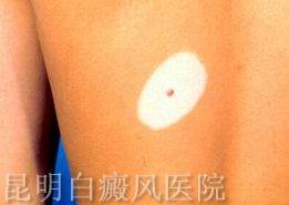 如何治疗白殿风才有效