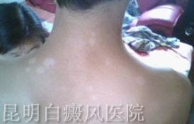 白癜风症状图片