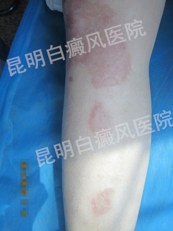 生活如此精彩 岂能因白癜风而毁坏